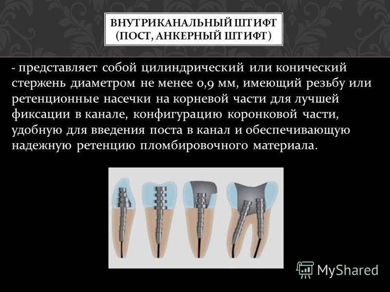 Что такое зубной штифт